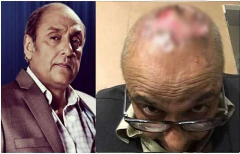 Pakistani Actor Syed Sajid Hasan Hair Transplant Goes Wrong Pakistani Actor Syed Sajid Hasan Hair Transplant Goes Wrong