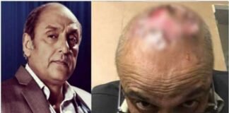 Pakistani Actor Syed Sajid Hasan Hair Transplant Goes Wrong